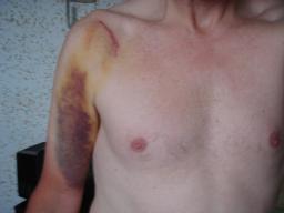 Injuries from cycle crash